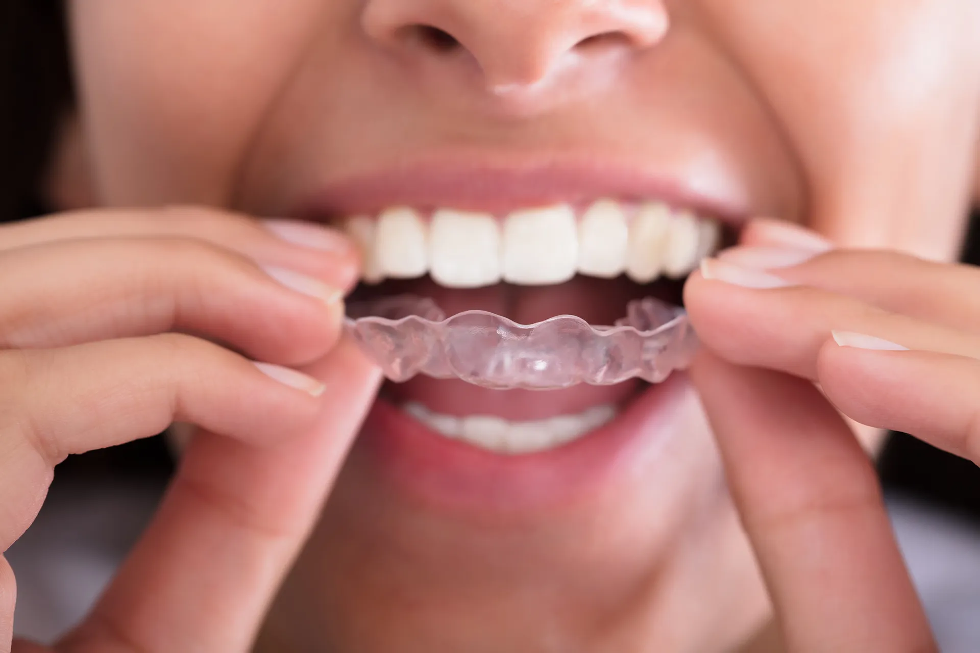 Orthodontiste Strasbourg 67000 Gouttière alignement